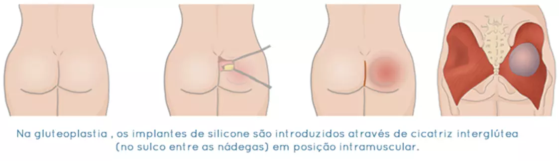 Gluteoplastia