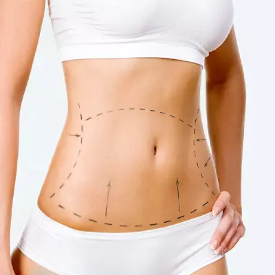 Abdominoplastia