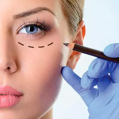 Blefaroplastia